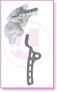 Spine Stainless Steel, Spine Titan, Product Instruments, Intervertebral Spacers, Bone Leaver, Elevator, Screws, Anchors, Arthroscopy, LCP Instruments Set, LCP Plates, Trauma Nail System, MND Interlocking Nailing System, Trauma Plates, Trauma, Trauma Screws