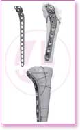 Spine Stainless Steel, Spine Titan, Product Instruments, Intervertebral Spacers, Bone Leaver, Elevator, Screws, Anchors, Arthroscopy, LCP Instruments Set, LCP Plates, Trauma Nail System, MND Interlocking Nailing System, Trauma Plates, Trauma, Trauma Screws